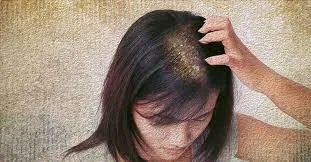 What dandruff treatment methods What are the signs and causes of dandruff