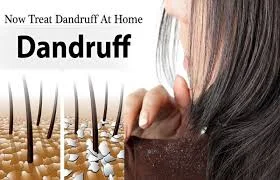 dandruff treatment methods signs and causes of dandruff