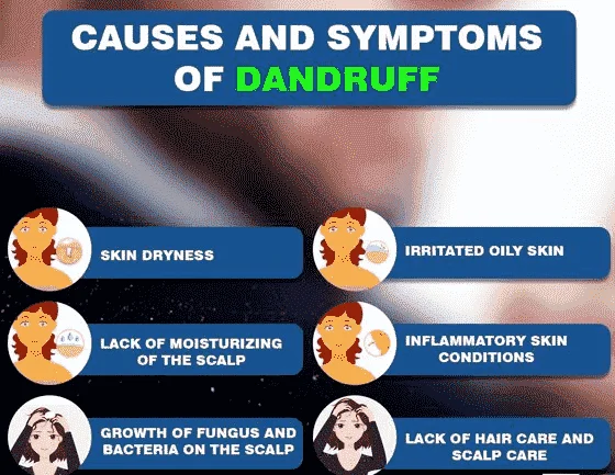 signs and causes of dandruff